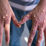 لاہور ؛8سال کی بچی میں منکی پاکس کی تصدیق