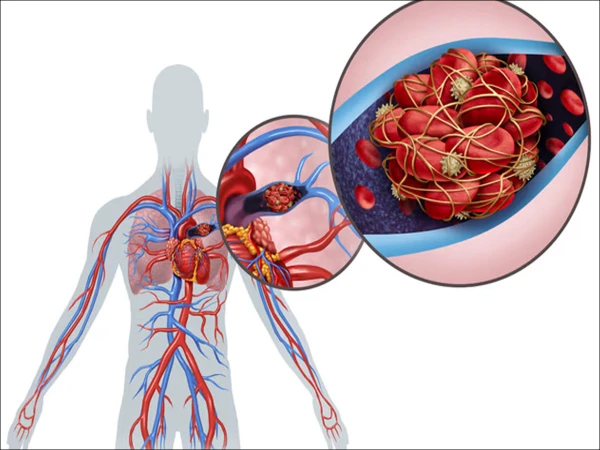پلمونری ایمبولزم: پھیپھڑوں کی شریانوں میں خون کا لوتھڑا پھنسنے کی بیماری جان لیوا ثابت ہو سکتی ہے، طبی ماہرین کا انتباہ
